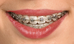 Self-Ligating Braces